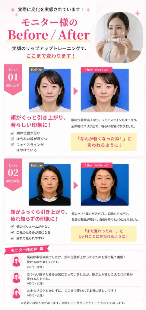 LipUp使用前後の比較（6か月で頬の位置とフェイスラインの印象が変化したイメージ）