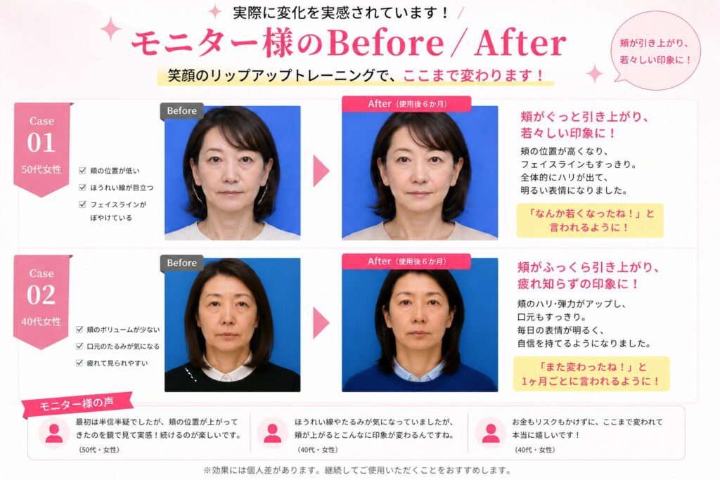 LipUp使用前後の比較（6か月で頬の位置とフェイスラインの印象が変化したイメージ）